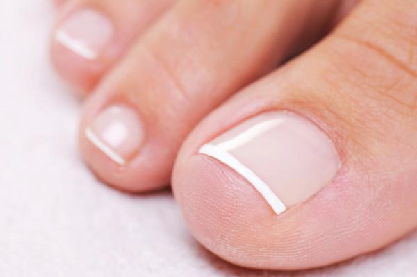 Протезирование ногтевой пластины (1 ноготь)